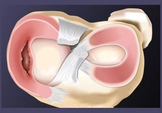 Ilustracion anatomica de rotura en asa de cubo de menisco - Dr Braulio Ayala Monterrey