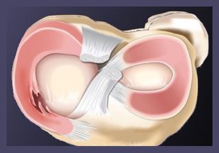Ilustracion anatomica de rotura compleja de menisco - Dr Braulio Ayala Monterrey