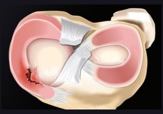 Ilustracion anatomica de rotura degenerativa de menisco - Dr Braulio Ayala Monterrey
