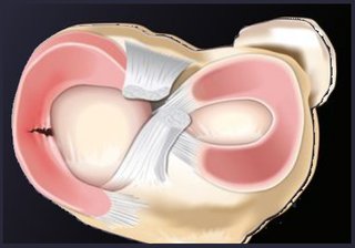 Ilustracion anatomica de rotura radial de menisco - Dr Braulio Ayala Monterrey